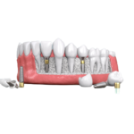 Dental Implant